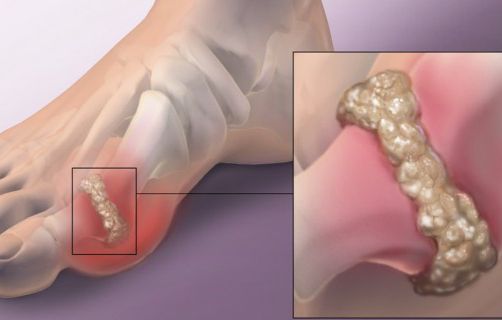 Gambaran ketika asam urat kambuh / Foto: net