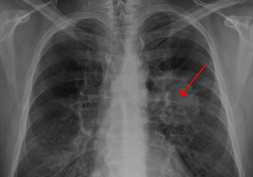 Tampilan kanker paru pada X Ray / Foto : wikipedia