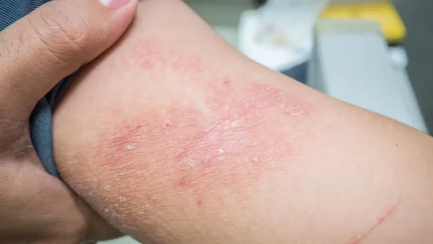 Aktual.co.id – Gatal tidak melulu karena digigit serangga atau alergi, namun rasa gatal di kulit bisa diakibatkan stress, depresi dan kecemasan. Gatal akibat depresi, stress dan kecemasan ini disebut Dermatitis, yakni peradangan atau iritasi di kulit yang umumnya ditandai dengan kulit gatal, kering, dan kemerahan. Umumnya, menurut data yang dihimpun, gatal dermatitis ini dialami oleh orang yang memiliki kecenderungan stress, cemas, dan depresi. Menurut kutipan alodokter, dermatitis bisa karena alergi, faktor genetik, system kekebalan tubuh, kurang tidur, atau mengalami depresi, gangguan cemas, maupun asma. Gejala pada umumnya adalah gatal, ruam dikulit, bersisik, ruam kemerahan, yang lokasinya bisa di berbagai titik di dalam tubuh, mulai kaki, tangan, ketiak bahkan sebagian kulit kepala. Pengobatan dermatitis disesuaikan dengan gejala yang dialami pasien. Sebagai contoh, dermatitis kontak akibat alergi akan hilang dengan sendirinya jika paparan alergen atau iritan penyebabnya dihilangkan. Oleh karena itu, pasien dianjurkan menghindari kontak dengan alergen dan zat iritan. Selain menghindari kontak dengan alergen dan zat iritan, pasien bisa menggunakan krim atau salep pelembap yang mengandung emolien. Pelembap ini bisa digunakan setelah mencuci tangan, mandi, atau saat kulit kering. Sementara untuk pencegahannya antara lain : -. Tidak mandi menggunakan air yang terlalu panas -. Menggunakan sabun dan sampo yang lembut atau khusus untuk kulit sensitif -. Mengoleskan pelembap dan tabir surya dengan rutin -. Menggunakan sarung tangan ketika mencuci jika mengalami iritasi terhadap deterjen atau sabun cuci -. Berolahraga rutin dan menerapkan pola makan sehat untuk memperbaiki sistem imun -. Berobat dan kontrol secara rutin ke dokter jika menderita asma atau penyakit terkait alergi lainnya Jika ada gejala yang semakin berat segera konsultasikan ke dokter untuk mendapatkan pengobatan dan perawatan yang lebih baik. (ndi)
