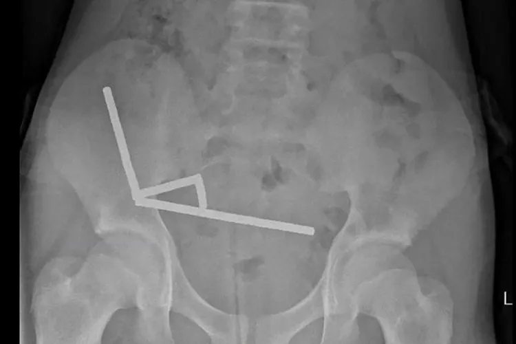 Hasil XRay yang memperlihatkan magnet di dalam tubuh pasien / Foto: People