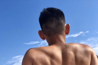 Ilustrasi terbakar surya/ Foto: freepik